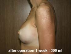 plastic-surgery-breast-augmentation 